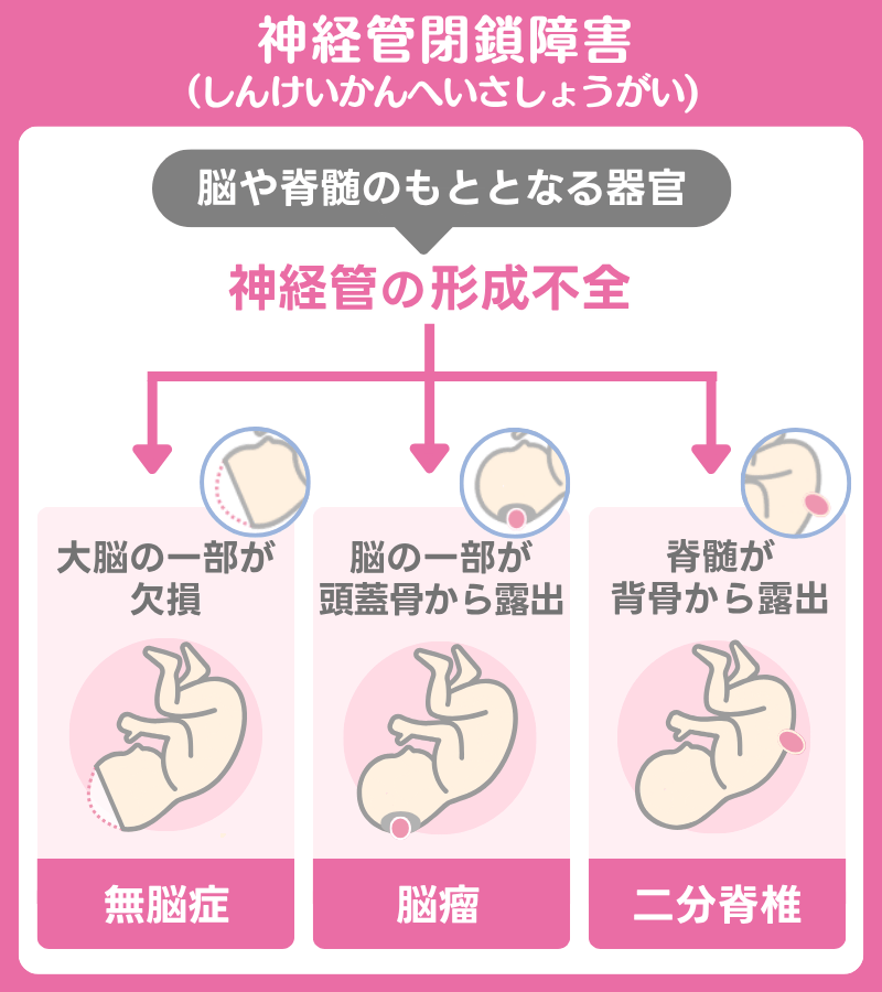神経管閉鎖障害とは