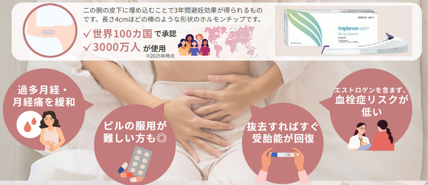 避妊皮下インプラントとは