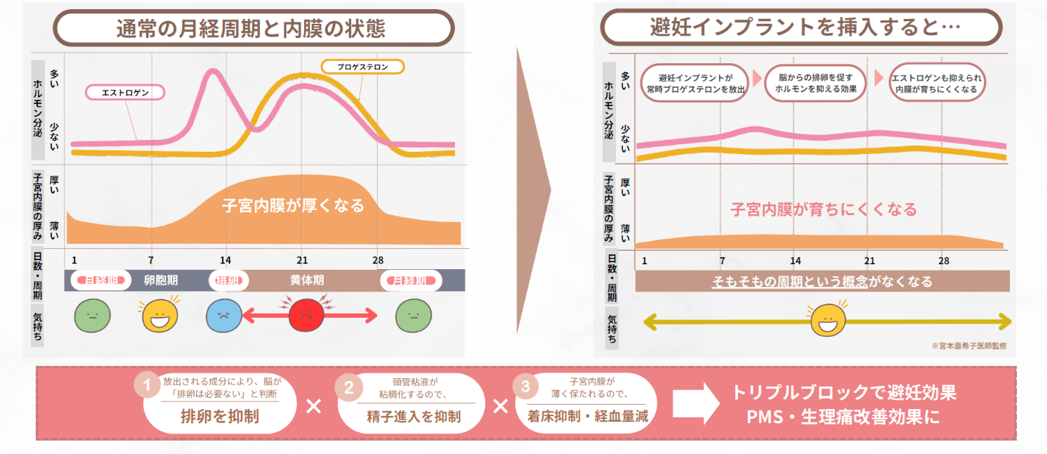 皮下（避妊）インプラントの仕組み